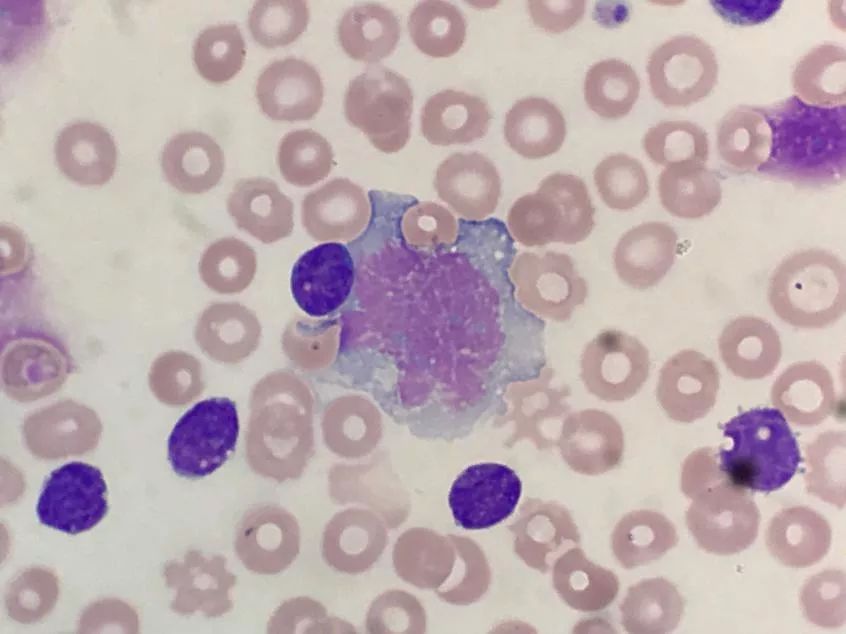 套细胞淋巴瘤胸腔侵润病例分享