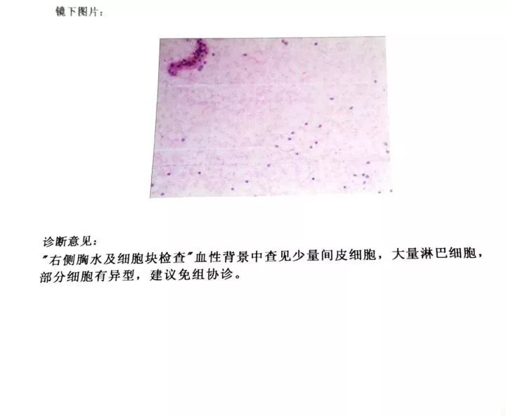 套细胞淋巴瘤胸腔侵润病例分享