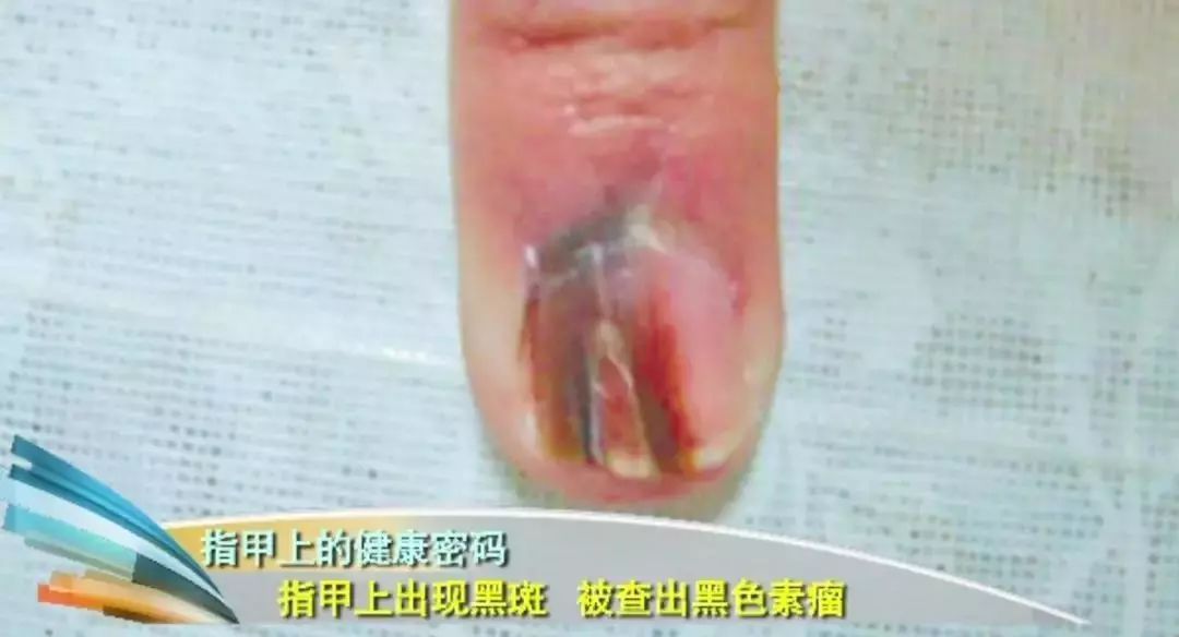 科普|指甲的态势反映了你身体的状况