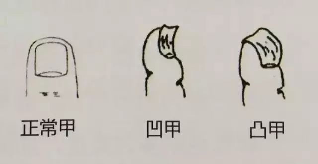 科普|指甲的态势反映了你身体的状况