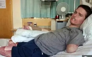 男子被恙虫咬致器官衰竭,男子惨遭蟒蛇吃掉险丧命