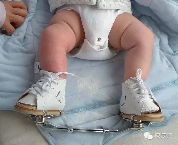 脑瘫儿童身体一侧倾斜怎么康复,儿童脑瘫肢体障碍表现