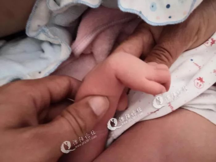 婴儿手脚畸形没查出来,新生儿手指畸形产检医院有责任么