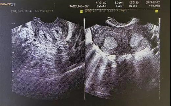 雅安恒博医院提醒：子宫有这道“墙”需及时“拆除”