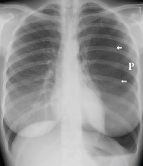致命胸痛的10个常见部位,致命性胸痛的常见病因有哪些