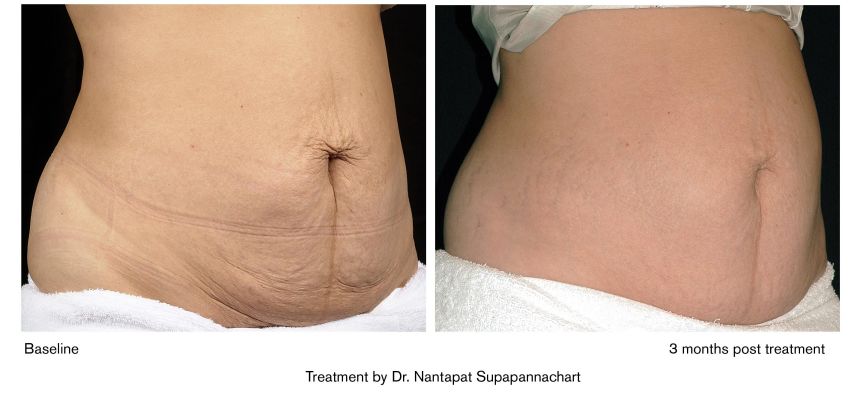 热玛吉抗衰老手术适应6类人群,了解热玛吉抗衰老看这篇就够了