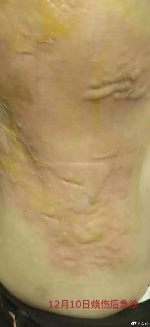 女子拔火罐胳膊烧伤,女明星拔火罐疼得要哭