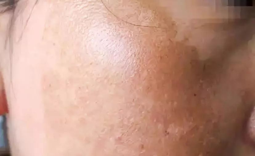 褐斑怎么消除最快方法,褐斑怎么用药膏去除