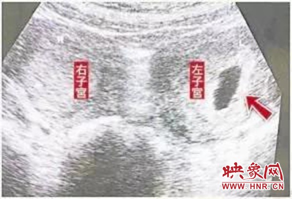 双子宫怀孕怎么睡觉好,天生2个子宫是双胞胎吗