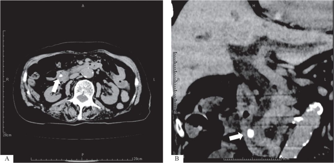 胆源性胰腺炎发病机制流程图,急性胆源性胰腺炎的鉴别诊断