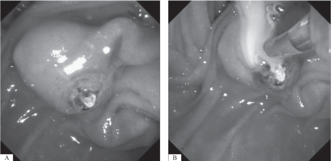 胆源性胰腺炎发病机制流程图,急性胆源性胰腺炎的鉴别诊断