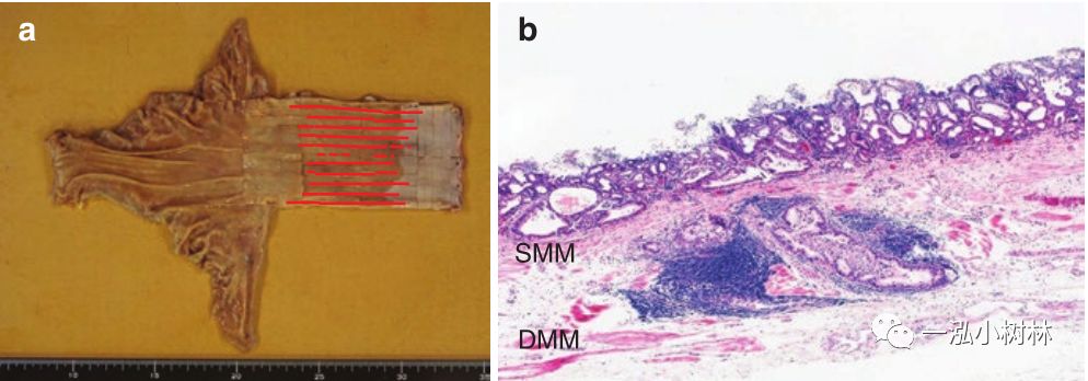 消化道早期癌内镜诊断技巧图谱,早期消化道肿瘤内镜下黏膜剥离术