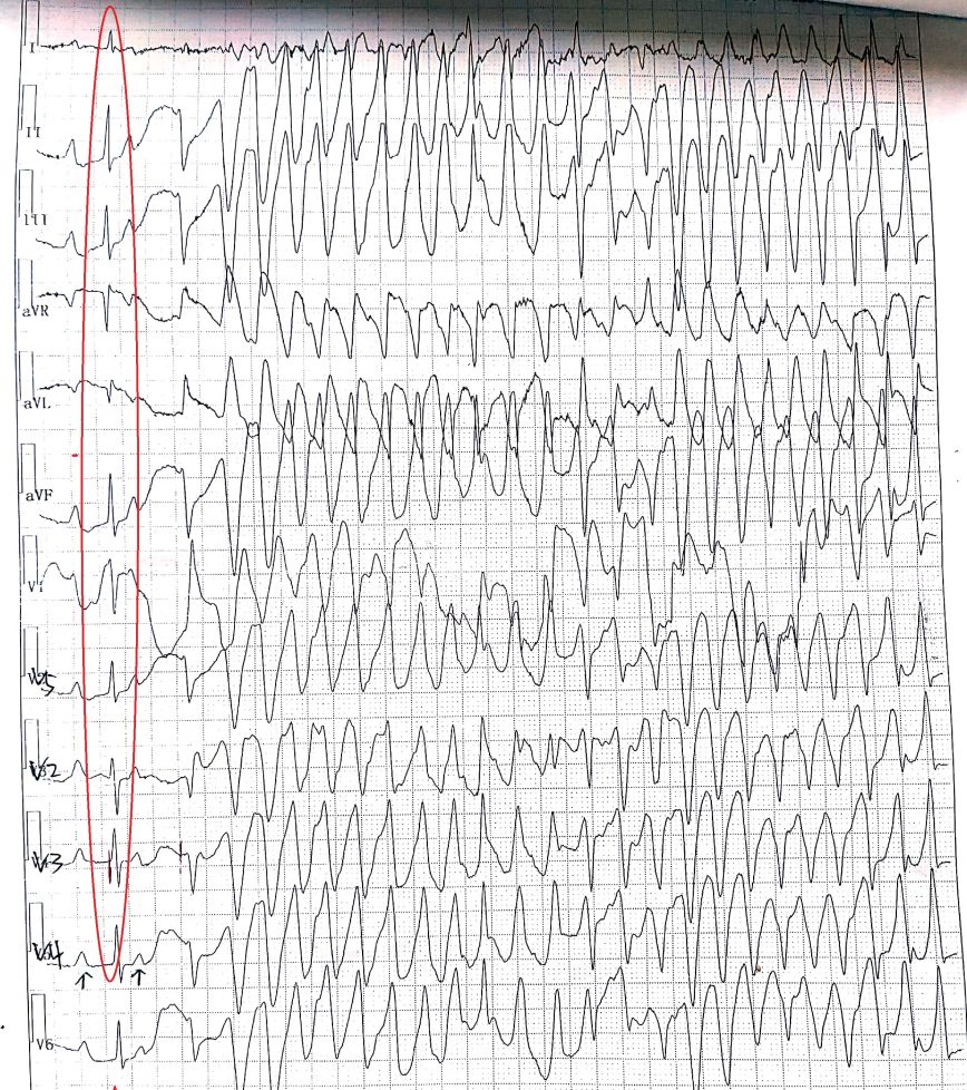 完全性房室传导阻滞病程进展,ii度i型房室传导阻滞治疗