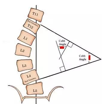 特发性脊柱侧弯的非手术康复治疗