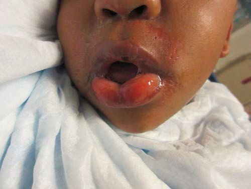 小孩吃干燥剂被腐蚀,一个小孩把干燥剂吃进了嘴里