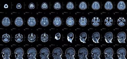 核磁共振与ct哪个辐射更高,脑ct与脑核磁共振哪个辐射大