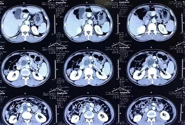 核磁共振与ct哪个辐射更高,脑ct与脑核磁共振哪个辐射大