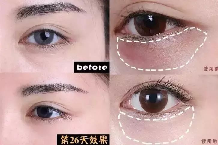 马应龙水晶眼膜视频,马应龙八宝多肽眼膜