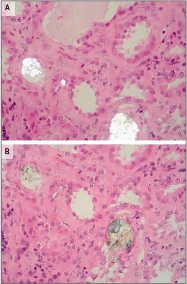 有非布司他导致的肾衰竭案例吗,奥利司他引起的病例