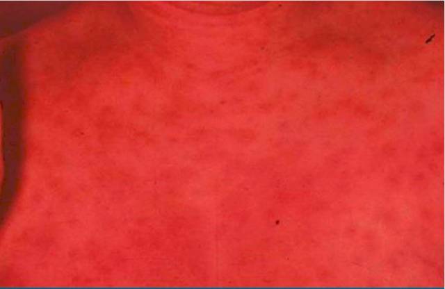 高热患儿出现充血性丘疹是什么病,儿童红斑狼疮病例