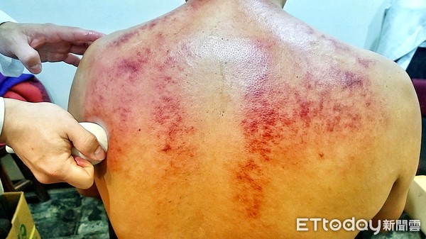 中医刮痧学关注事项,中医基础知识自学入门刮痧