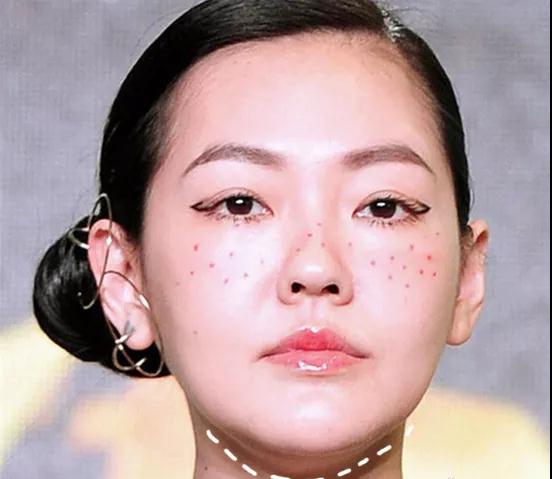 迷人计丨下颚骨太窄也会“胖”出双下巴？小S十元是这样让骨骼归正的
