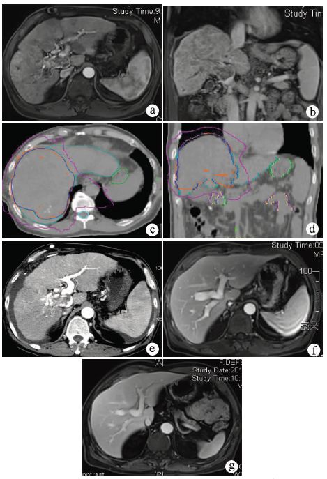 专家访谈肝癌,曾昭冲给谁治疗过
