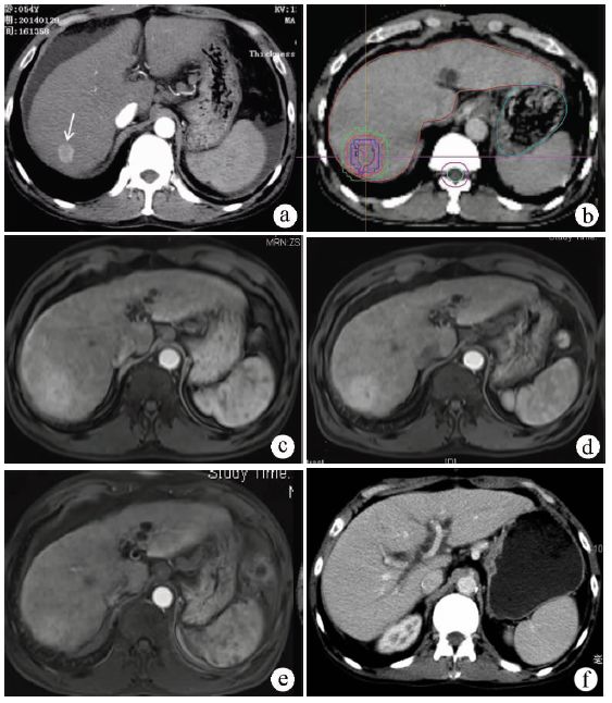 专家访谈肝癌,曾昭冲给谁治疗过