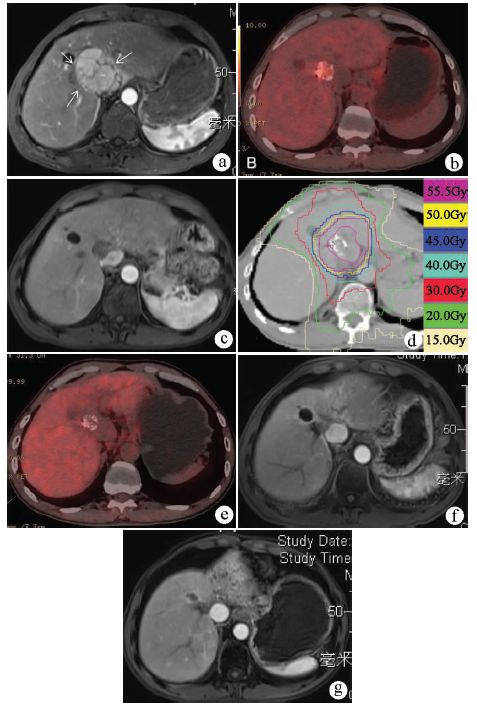 专家访谈肝癌,曾昭冲给谁治疗过