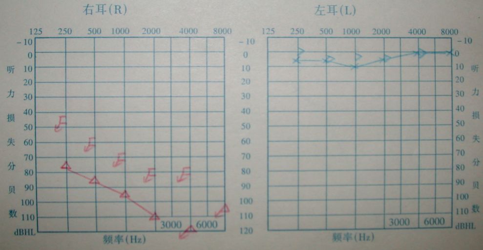 爱耳日听力突然降落了怎么办,爱耳日耳聋
