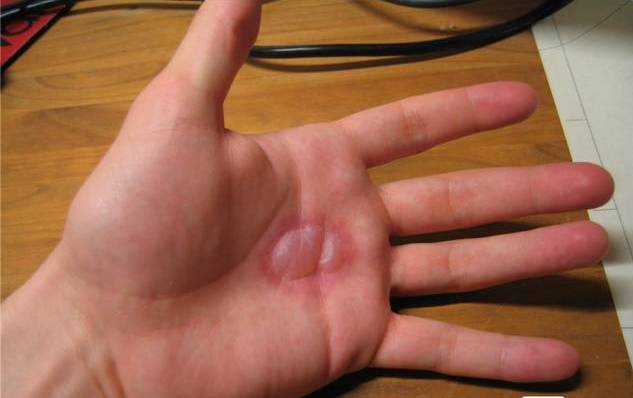 穿着衣服被开水烫伤急救,开水烫伤的急救措施