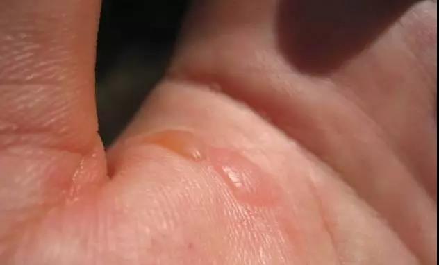 穿着衣服被开水烫伤急救,开水烫伤的急救措施