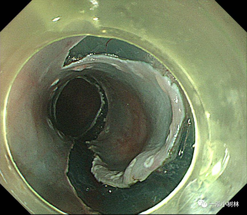 食管癌早期内镜esd治疗能活多久,食管癌内镜esd手术后几天出院