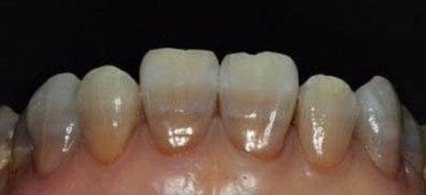 青岛治疗牙齿最佳方法,牙齿发黄怎么办最快解决方法