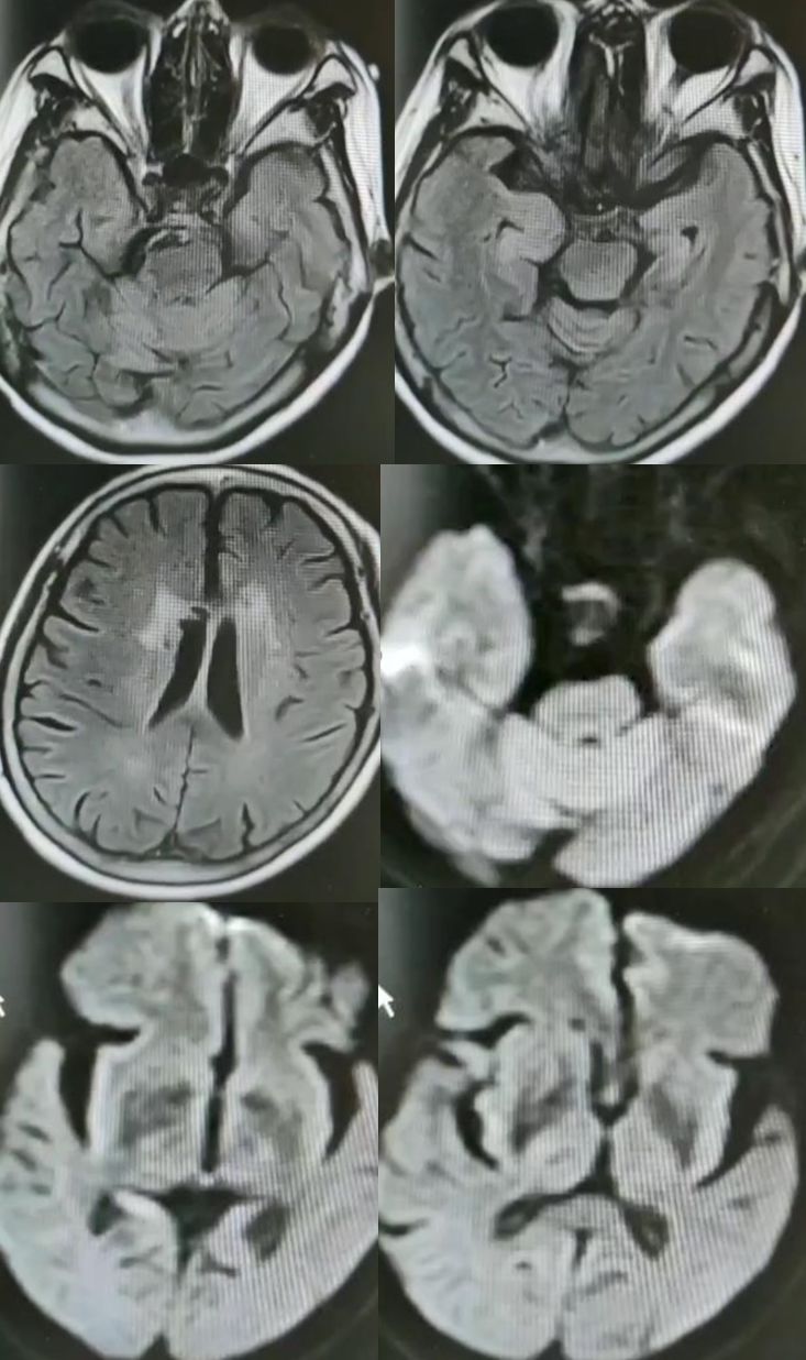 颈内动脉血栓和闭塞,颈内动脉漂浮血栓