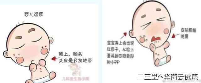 湿疹护理方法,如何护理宝宝湿疹的方法视频