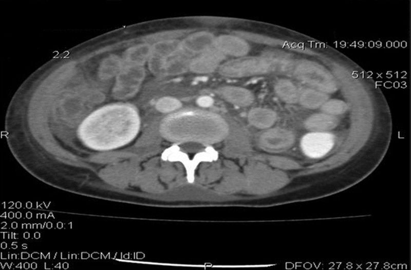 女性腹痛常见疾病,腹痛伴有腹水怎么回事