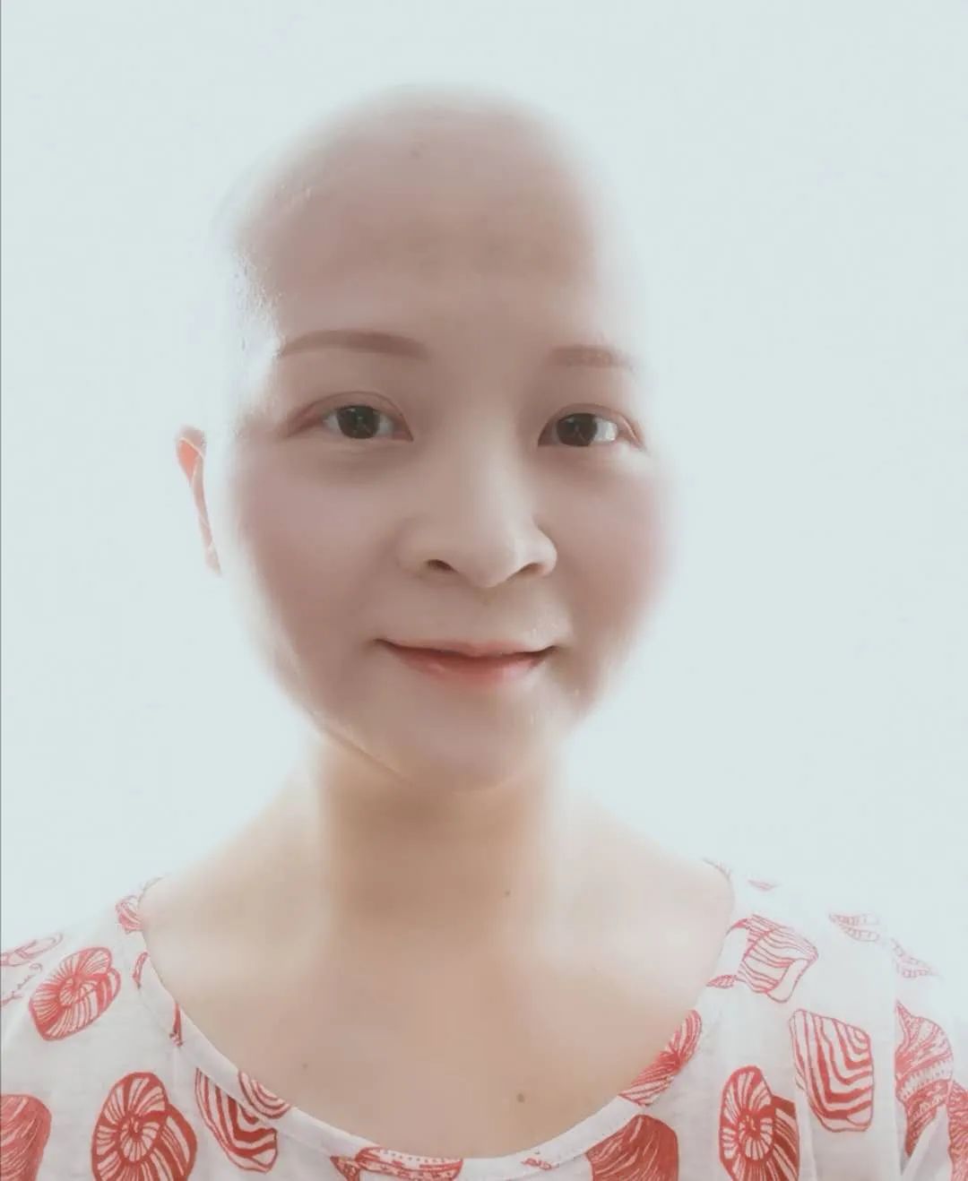 怀疑骨转移已经过了两年了都没事,疑似骨转移4年没变化