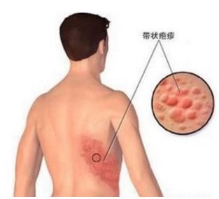 近日大连这种病重症患者明显增多！中老年人易患病