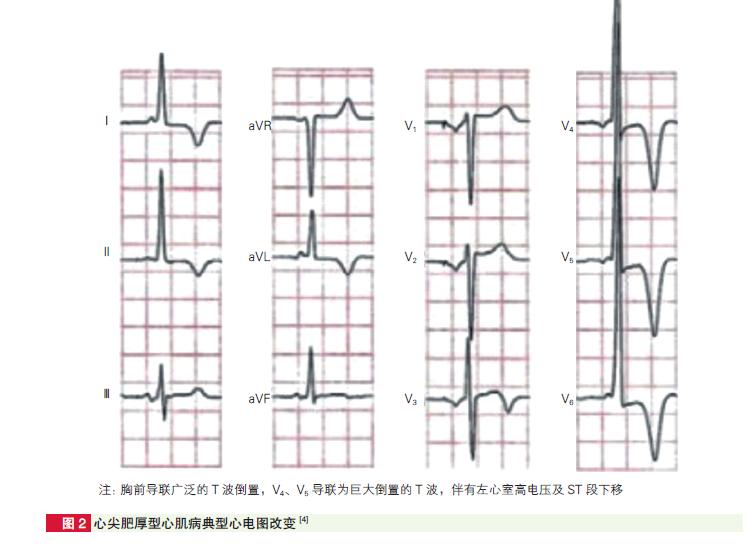心尖肥厚型心肌病心电图表现,肥厚型心肌病心电图