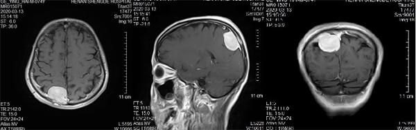 矢状窦旁脑膜瘤手术成功案例,天坛医院矢状窦旁脑膜瘤做手术