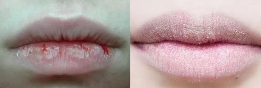 拒绝皮肤干裂带来的尴尬,唇部保养tips教程