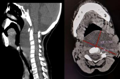 青岛妇儿医院：颈部巨大淋巴管瘤险窒息“微创”精准施治挽救患儿生命