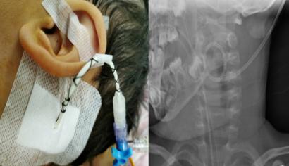 青岛妇儿医院：颈部巨大淋巴管瘤险窒息“微创”精准施治挽救患儿生命