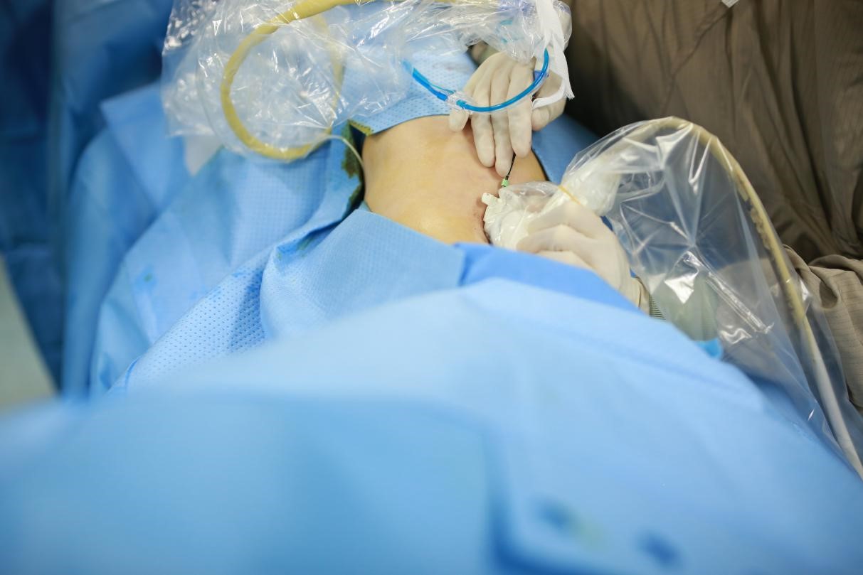 超声治疗肿瘤,肿瘤超声治疗