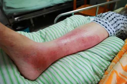 暴雨引发的疾病,暴雨容易引发的疾病