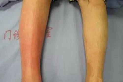 暴雨引发的疾病,暴雨容易引发的疾病