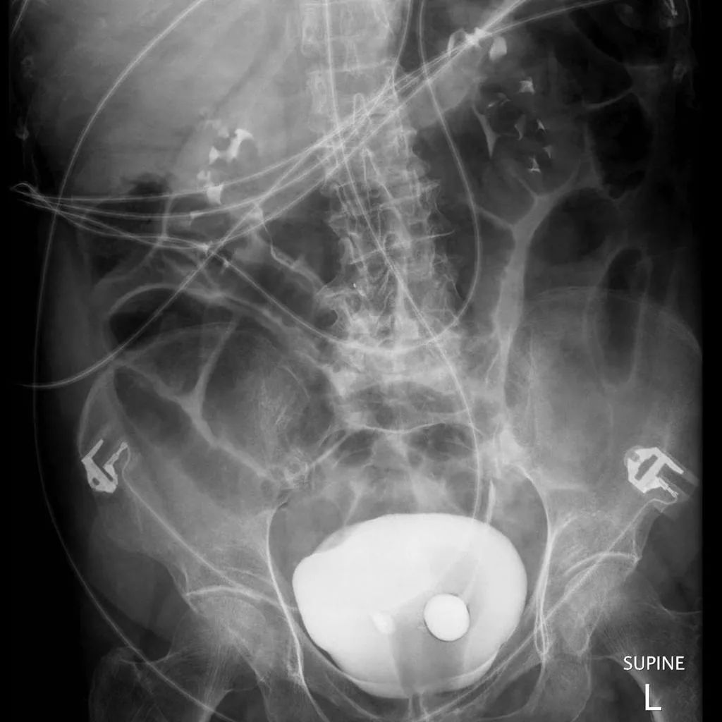 肾积水、排尿困难、脓尿、IVP蛇头征