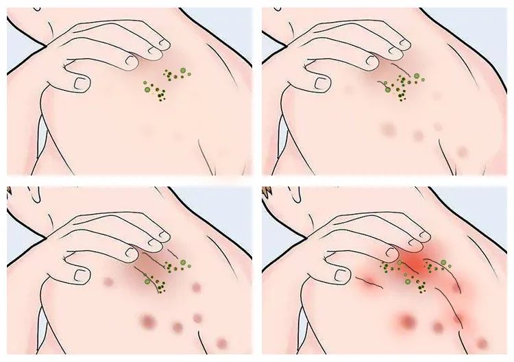 长小水泡很痒用什么中药,皮肤止痒起包用哪个药膏