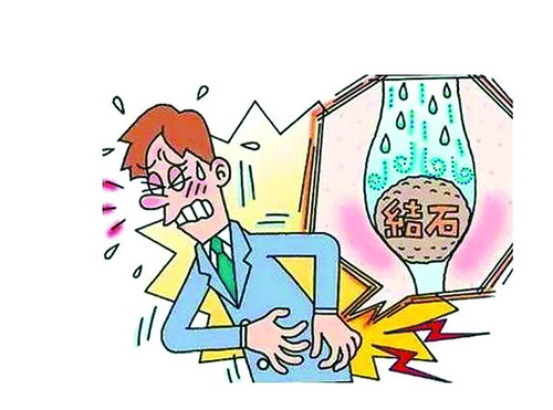 小结石发作要住院吗,小结石体检怎样避免